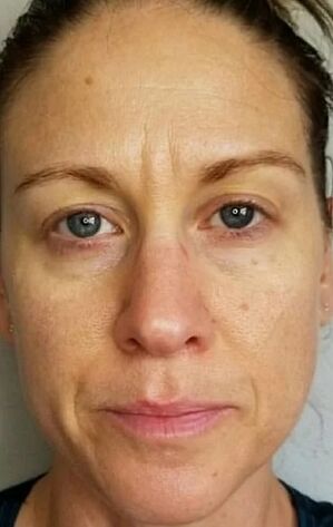 Im Alter von 40 Jahren erschienen tiefe Falten und Flecken des Alters